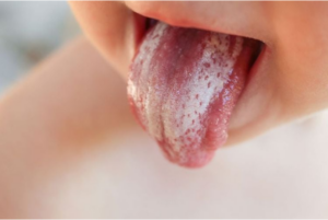 Oral Thrush