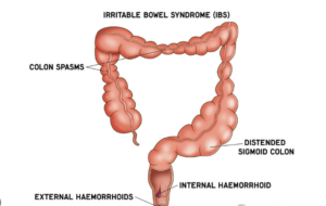 Irritable Bowel Syndrome