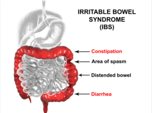 Irritable Bowel Syndrome