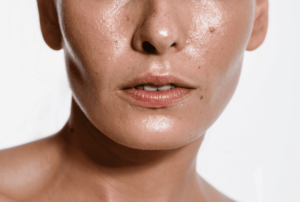 Enlarged Pores and Oily Skin