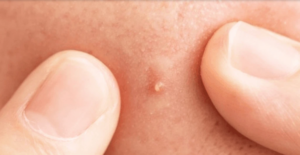 Whitehead Inflammatory Acne