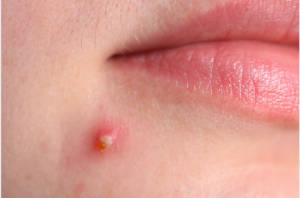 Whitehead Inflammatory Acne